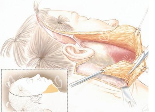 微拉美手术过程图图片