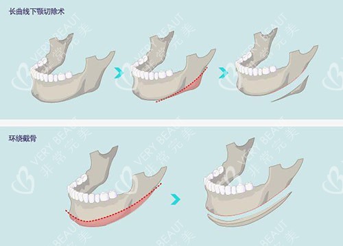 长曲线下颌角手术示意图
