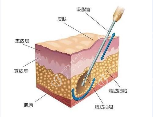 面部吸脂原理图片