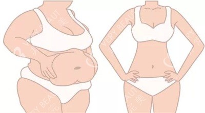 吸脂减肥对比图