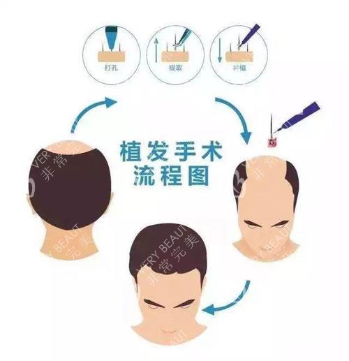 头顶加密植发手术流程
