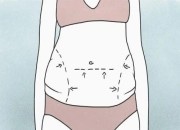 腰腹吸脂为什么要穿塑身衣？有没有不穿塑身衣的吸脂技术？