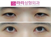 韩国来丽整形外科怎么样，眼修复/双眼皮/眼部提肌都很出名