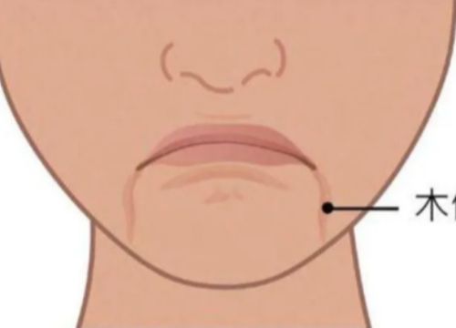 嘴角纹要怎么消除？注射玻尿酸可以吗？
