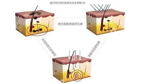 激光去痣原理