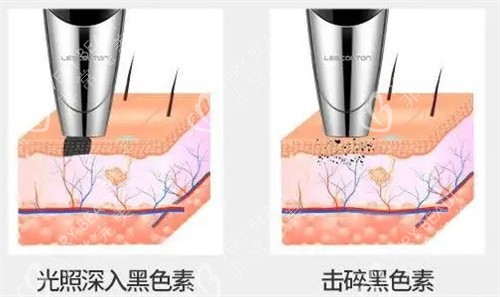 激光消除黑色素