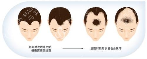 脱发步骤动画演示图