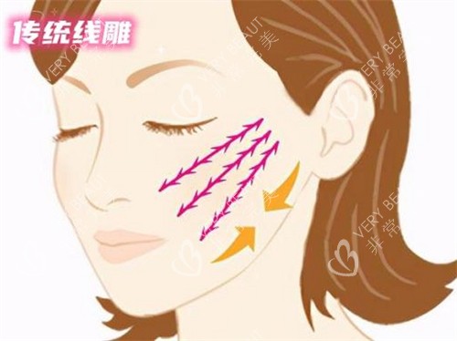 苹果肌线雕提升术动画演示图