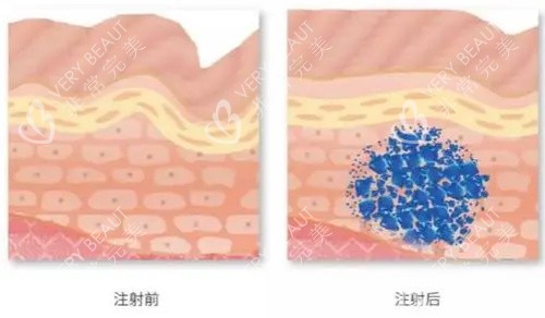 简妍玻尿酸注射前后示意图