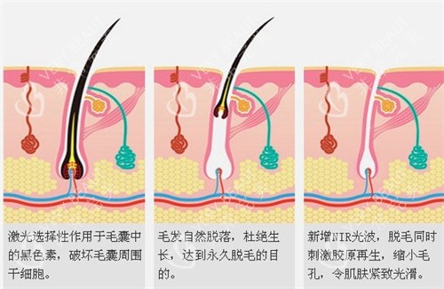 激光脱毛原理
