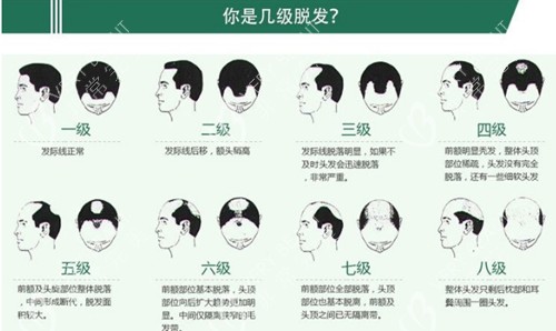 脱发等级图示