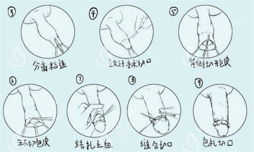 割包皮手术过程