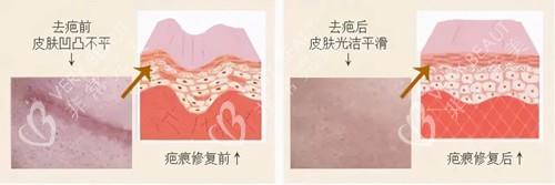 激光祛疤卡通示意图