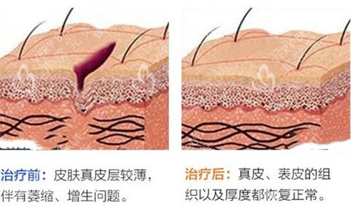 激光祛疤前后对比示意图