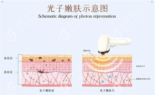 光子嫩肤示意图