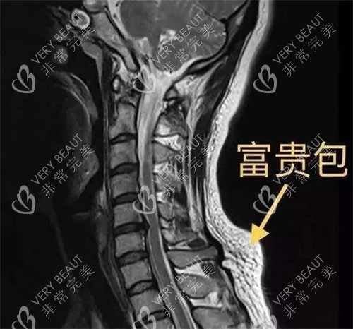 CT下的富贵包图示