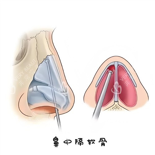 鼻中隔软骨演示动画图