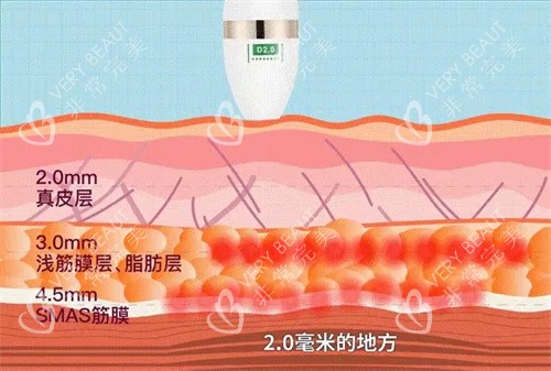 超声炮层次