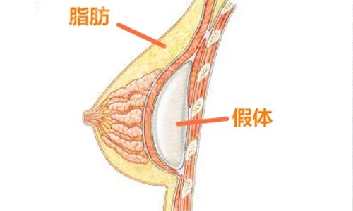 复合隆胸示意图