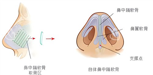 隆鼻鼻中隔软骨鼻