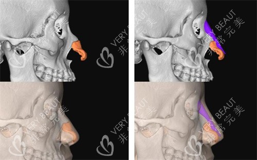 FITme3D鼻假体使用对比展示