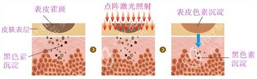 激光去除黑色素原理动画图