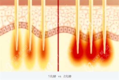 黑曜双波黄金微针双波发射模式
