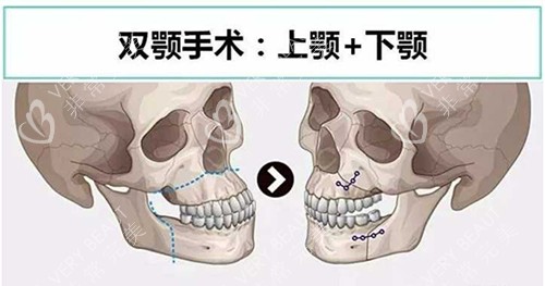 双鄂手术