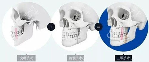 正颌