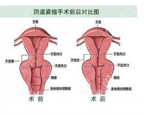 阴道紧缩手术前后对比图