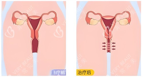 生物束带紧缩术原理动画演示图