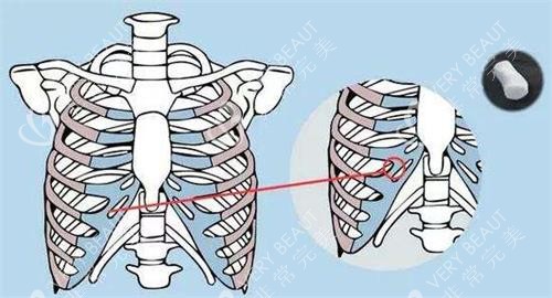 肋骨鼻的肋骨取出位置