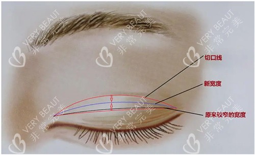 双眼皮肉条修复术原理