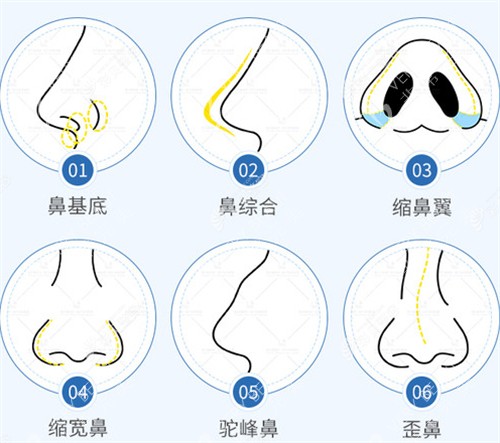 不同隆鼻技术图解