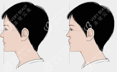 鼻基底填充前后对比卡通示意图