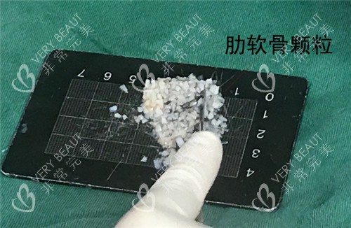 肋骨碎填充鼻基底材料