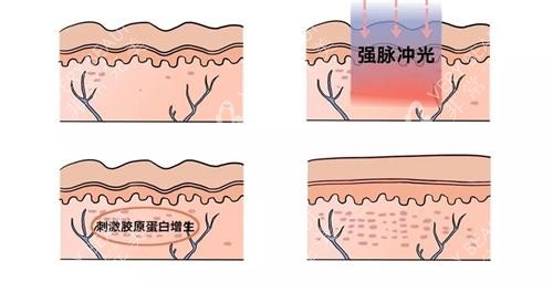 光子嫩肤的祛斑过程