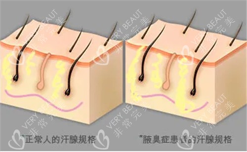 汗腺对比图