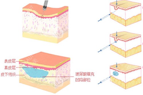 玻尿酸填充皮下组织示意图