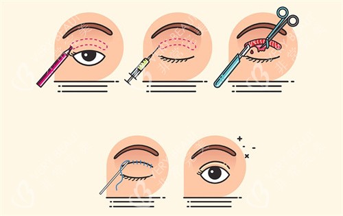 埋线双眼皮过程卡通图