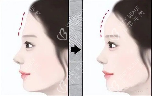 填充额头手术前后对比动画图