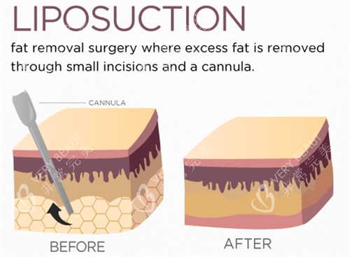 吸脂手术前后动画对比