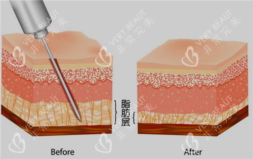 吸脂前后对比照