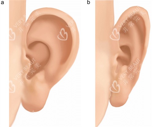 改善耳朵形状