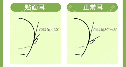 贴面耳与正常耳颅耳角对比图