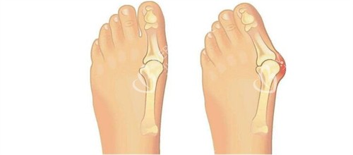 大脚骨手术前后对比