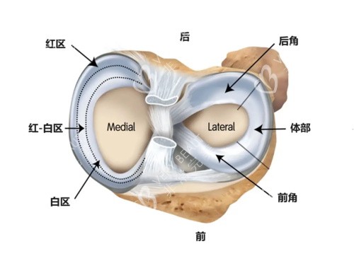 半月板损伤展示示意图
