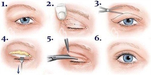 双眼皮全切术过程图