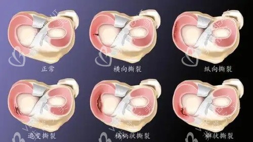 半月板损伤步骤示意图