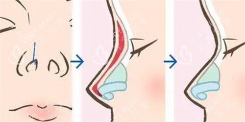 隆鼻手术过程